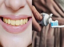 ۴ دلیل برای زردی دندان ها را بشناسید