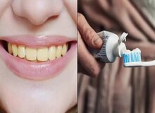 ۴ دلیل برای زردی دندان ها را بشناسید