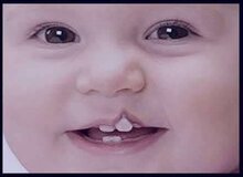 دلایل ابتلاء به یکی از شایع‌ترین بیماری‌های مادرزادی سر و گردن