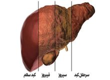 دلایل اصلی‌ بیماری کبد چرب چیست؟