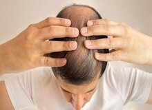 این داروی درمان ریزش مو باعث ایجاد افکار خودکشی می‌شود
