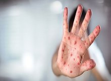 هشدار وزارت بهداشت درباره تبلیغات علیه واکسیناسیون سرخک در شبکه‌های اجتماعی