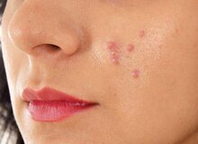 از ارتباط بین آکنه‌های پوستی با قند و شکر چه می‌دانید؟