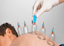 ۸ نکته درباره حجامت از درمان میگرن تا فشار خون