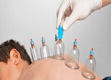 ۸ نکته درباره حجامت از درمان میگرن تا فشار خون