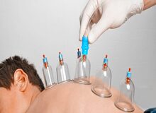 ۸ نکته درباره حجامت از درمان میگرن تا فشار خون