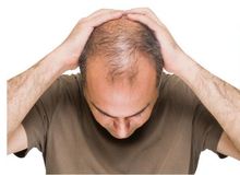 ۵ راه مبارزه با ریزش مو پس از بهبودی کرونا