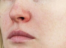 چگونه در چند روز خشکی و پوسته‌های اطراف بینی را برطرف کنیم؟
