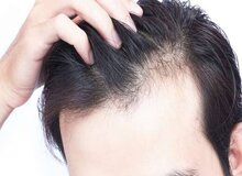 ۵ روش موثر برای جلوگیری از ریزش موی سر