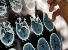 با مصرف این لبنیات از آلزایمر نجات پیدا کنید