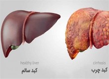 با داشتن این  ۱۶ علامت  به "کبد چرب" مبتلا هستید