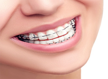 بعد از ارتودنسی دندان ها چه کنیم؟