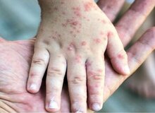 هشدار مهم! زنگ خطر «سرخک» در این مناطق کشور