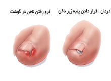 وقتی ناخن پا در گوشت فرو می رود