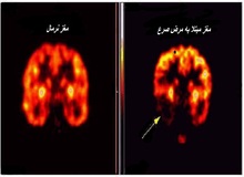 ۷۰۰ هزار نفر در ایران بیماری صرع دارند