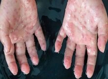 بیش از ۵۰ هزارنفر به آبله میمون مبتلا شدند