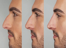 انجام عمل جراحی بینی برای این ۱۹ گروه بسیار خطرناک است