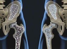 با این روش از ابتلا به پوکی استخوان فرار کنید